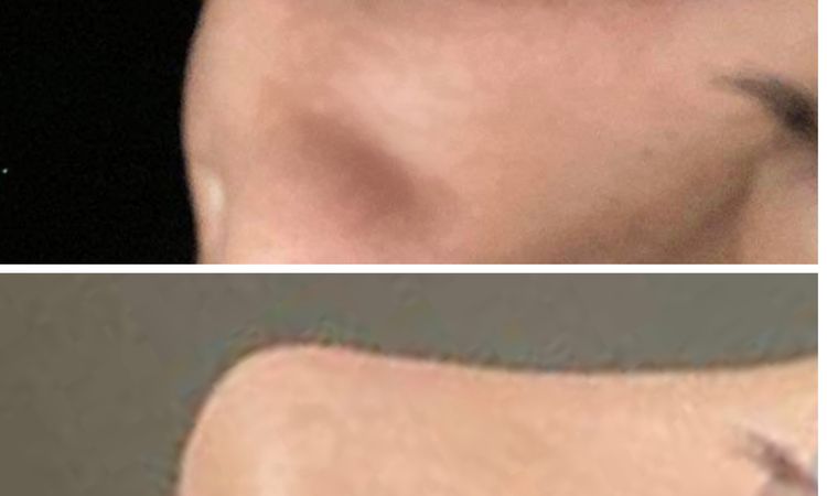 Efectos de la triamcinolona tras 1 años de Rinoplastia - 58760