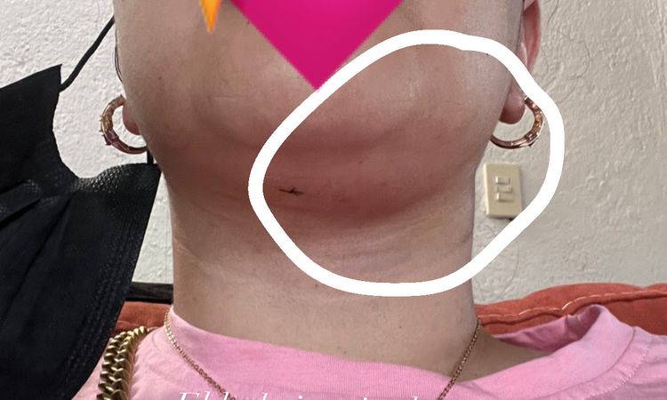 Asimetría tras lipopapada y bichectomía - 58855