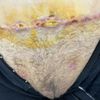 Me cortaron de mas en abdominoplastia?