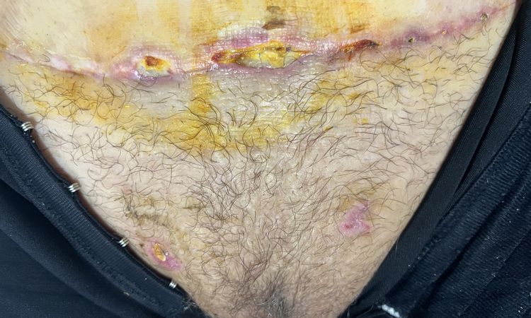 Me cortaron de mas en abdominoplastia? - 59340