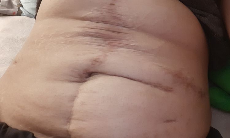 Mi abdomen tiene arreglo? - 59432