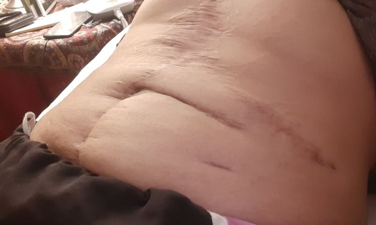 Mi abdomen tiene arreglo? - 59433