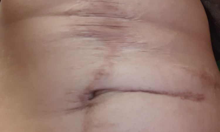Mi abdomen tiene arreglo? - 59434