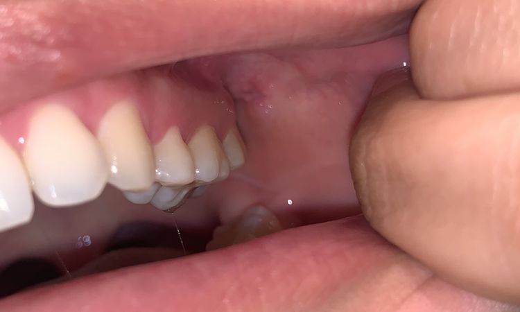 Dolor después de mi cirugía de bichectomia - 59987