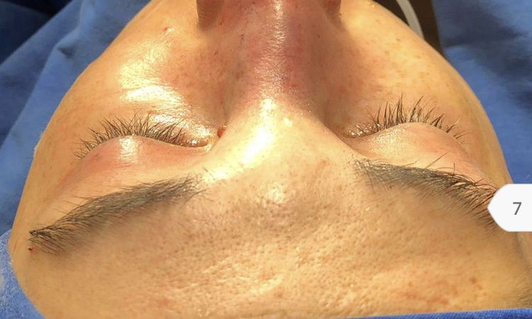 Rinoplastia Primaria Desviada - 60130