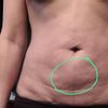 Liposuccion despues de 2 meses.