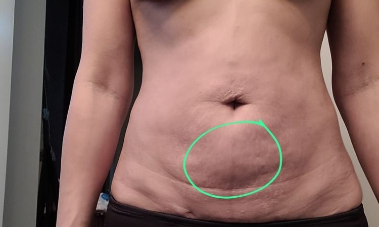 Liposuccion despues de 2 meses. - 60235