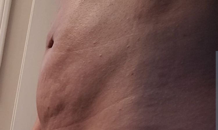 Liposuccion despues de 2 meses. - 60236