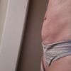 Liposuccion despues de 2 meses.