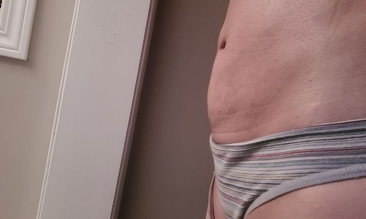 Liposuccion despues de 2 meses. - 60237