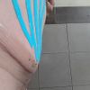 Seroma a dos meses de lipectomia