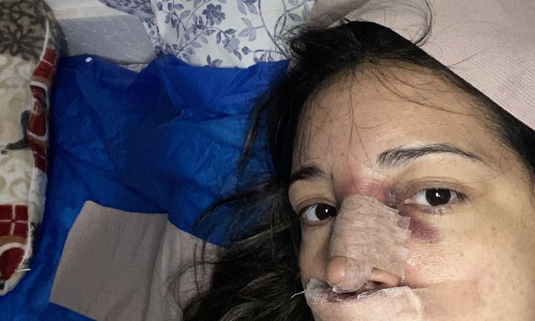 Nariz con deformidad, malposición de cartílagos alares - 63918
