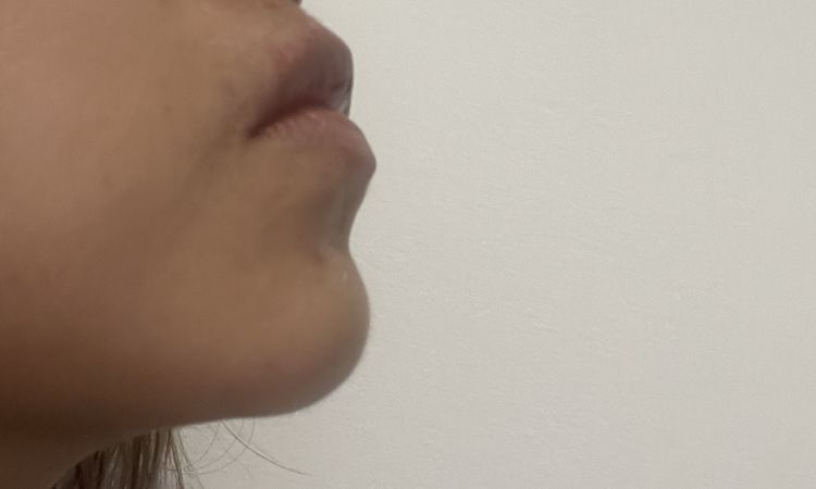 Después de mi rinoplastia tuve un Hundimiento de la columela - 64500