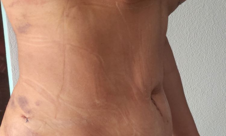 Duda sobre mi abdomino, el ombligo de ve fatal Ayuda. - 65568