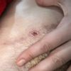 Herida abierta tras 5 meses de abdominoplastia
