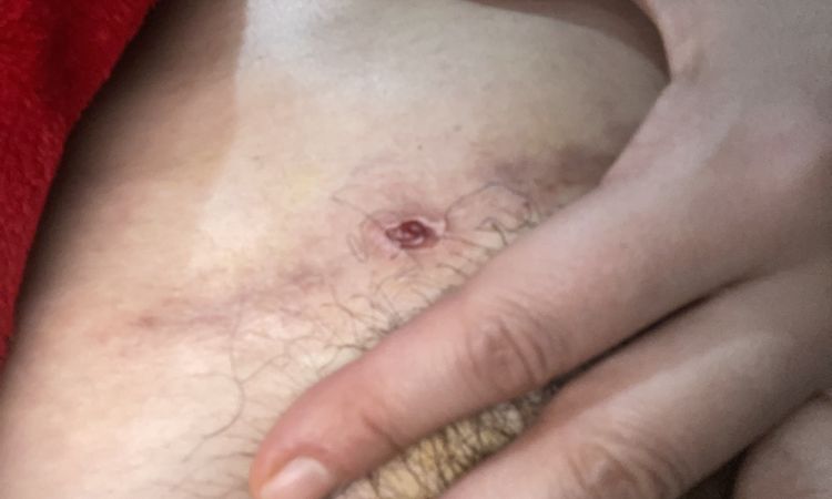 Herida abierta tras 5 meses de abdominoplastia - 65720
