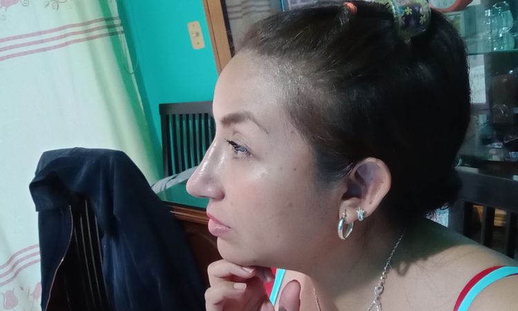 Inflamación tras rinoseptumplastia secundaria - 65919