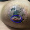 Heridas tras aumento de pecho que no sanan