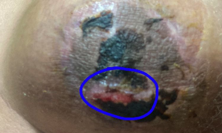 Heridas tras aumento de pecho que no sanan - 66186
