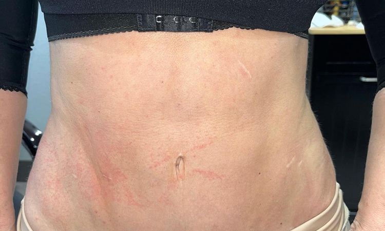 Lipo marcación irregular. Tras aplicar enzimas PB la piel se despegó - 66828