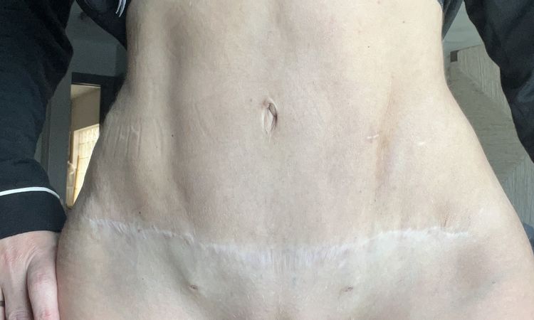 Lipo marcación irregular. Tras aplicar enzimas PB la piel se despegó - 66829