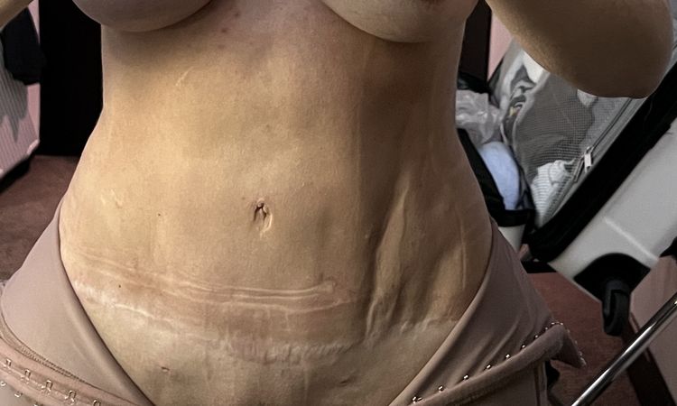 Lipo marcación irregular. Tras aplicar enzimas PB la piel se despegó - 66830