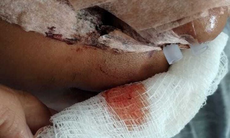 Hace 4 días me hicieron una rinoceplastia sangra mucho lado derecho - 68997