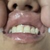 Aumento de labios tras reconstrucción 5 días con molestias