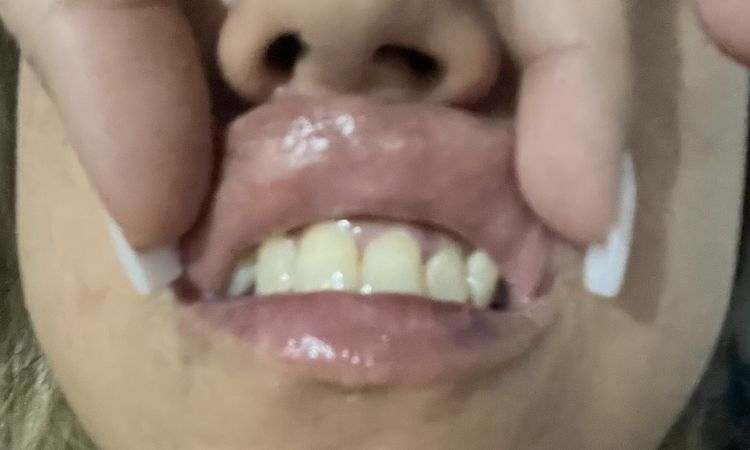 Aumento de labios tras reconstrucción 5 días con molestias - 69041