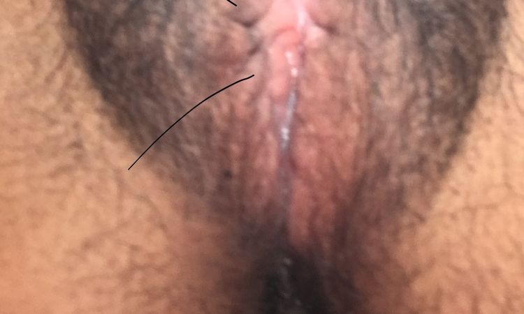 Como puedo mejorar ya que me lastima mucho mi labio genital - 69088