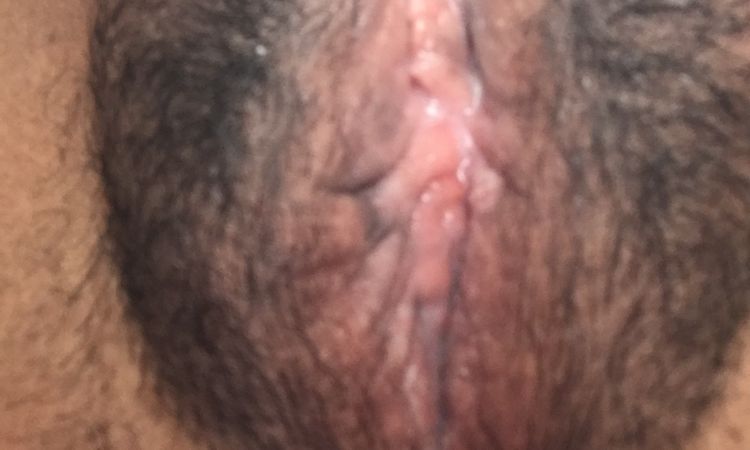 Como puedo mejorar ya que me lastima mucho mi labio genital - 69091