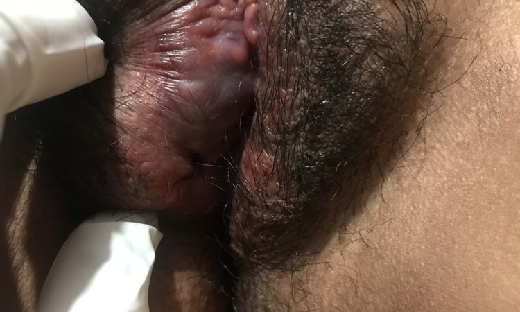 Piel plisada y amputación de labios menores después de labioplastia - 69795