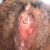 Cicatriz endurecida que formó un callo después de labioplastía