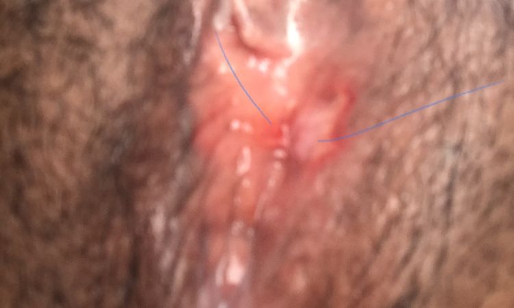 Cicatriz endurecida que formó un callo después de labioplastía - 70394