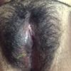 Cicatriz endurecida que formó un callo después de labioplastía