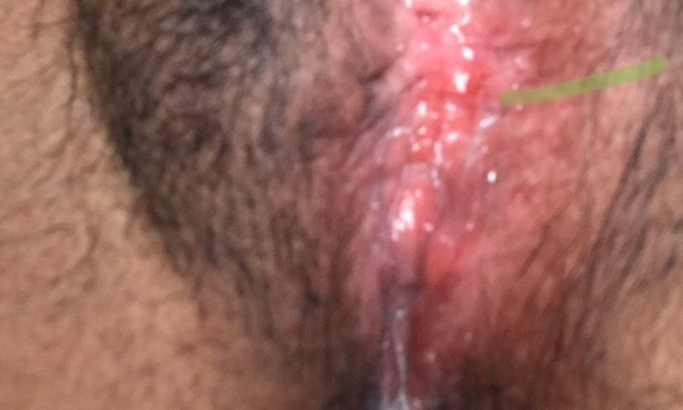 Cicatriz endurecida que formó un callo después de labioplastía - 70399