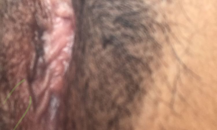 Cicatriz endurecida que formó un callo después de labioplastía - 70401