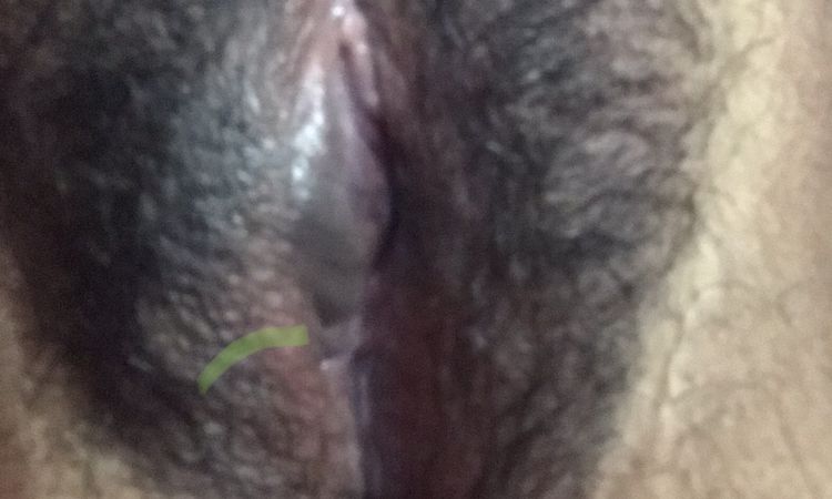 Cicatriz endurecida que formó un callo después de labioplastía - 70402
