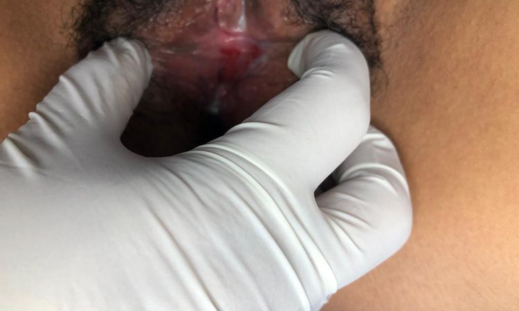 Cicatriz endurecida que formó un callo después de labioplastía - 70403