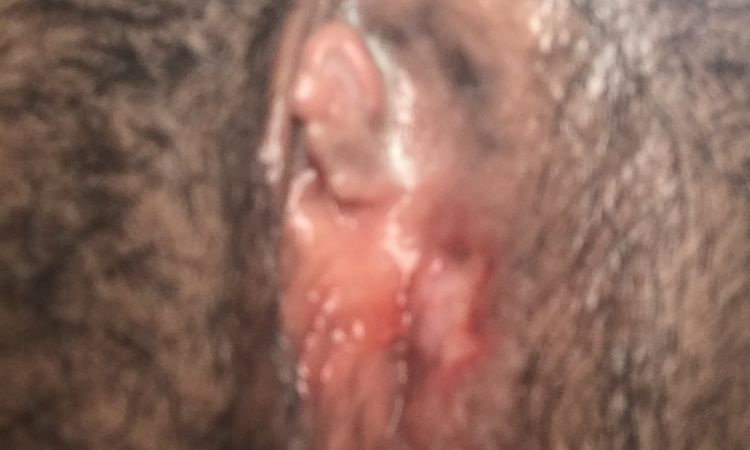 Cicatriz endurecida que formó un callo después de labioplastía - 70409