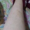 Manchas en las piernas