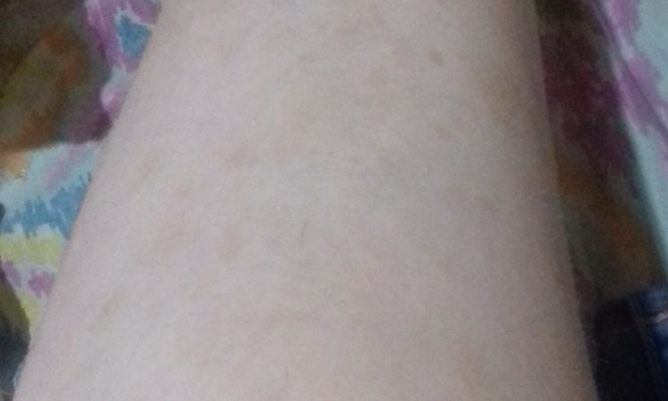 Manchas en las piernas - 73153