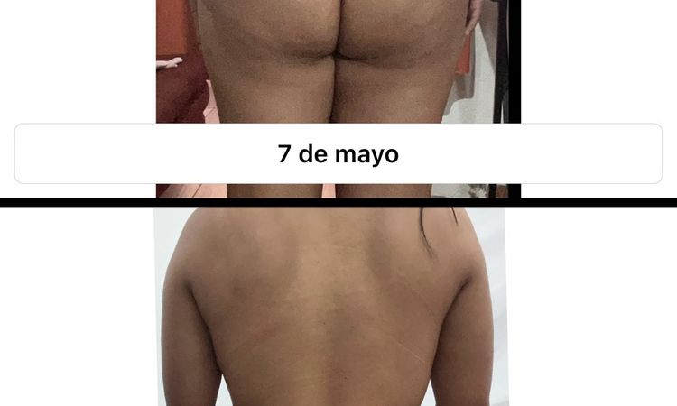 Corrección de glúteo post lipotransferencia - 77195