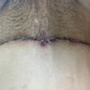 Costra en abdominoplastia que al caer dejó un agujero