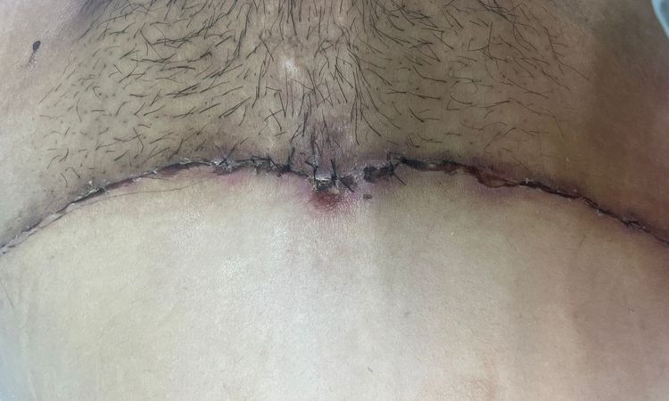 Costra en abdominoplastia que al caer dejó un agujero - 79034