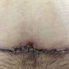 Costra en abdominoplastia que al caer dejó un agujero