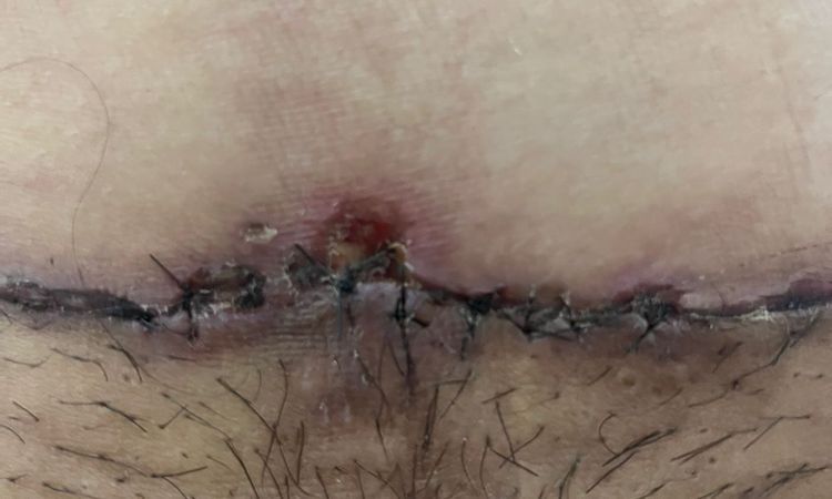 Costra en abdominoplastia que al caer dejó un agujero - 79035
