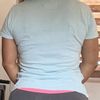 Cambios en glúteos porst lipoinyeccion