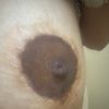 Es posible realizarme una 3er mastopexia y que me hagan proyección de pezon?