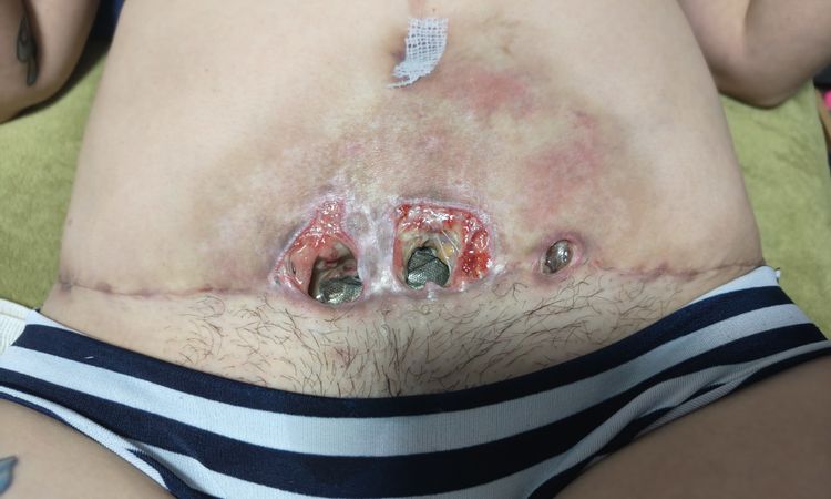 Hoyo y liquido en adminoplastia después de 1mes y medio - 81498